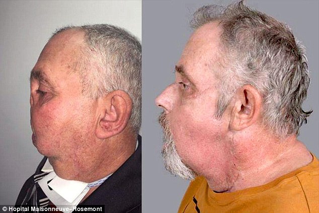 He lost his face in a horrible hunting accident what he had after a 30hr surgery is absolutely amazing | politics